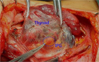 An improved method of searching inferior parathyroid gland for the patients with papillary thyroid carcinoma based on a retrospective study